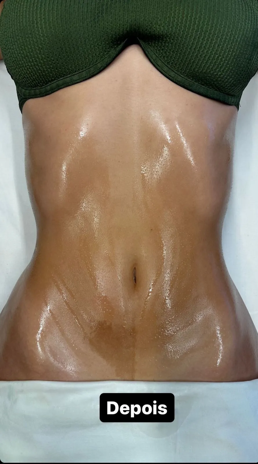 Depois — Resultado imediato da lipoescultura manual Miracle Touch